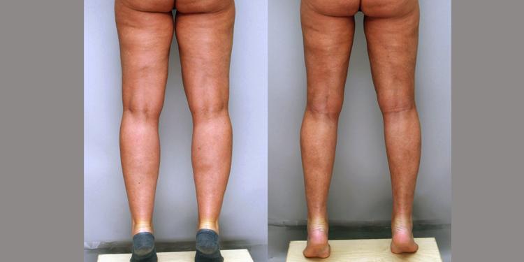 Ditesheim Cosmetic Surgery result — Charlotte, NC