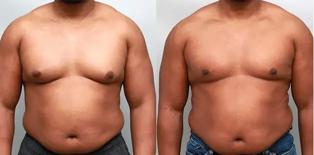 Ditesheim Cosmetic Surgery gynecomastia result — Charlotte, NC