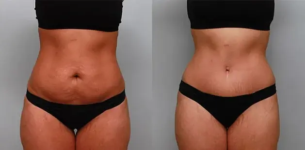 Mini Tummy Tuck result at Ditesheim Cosmetic Surgery in Charlotte, NC
