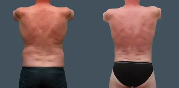 Liposuction result at Ditesheim Cosmetic Surgery in Charlotte, NC