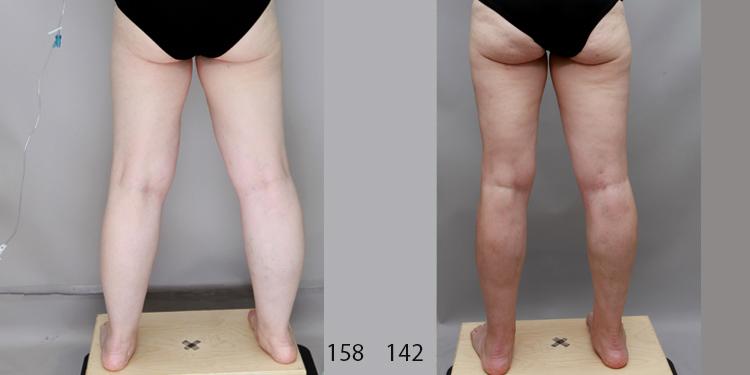 Ditesheim Cosmetic Surgery result — Charlotte, NC