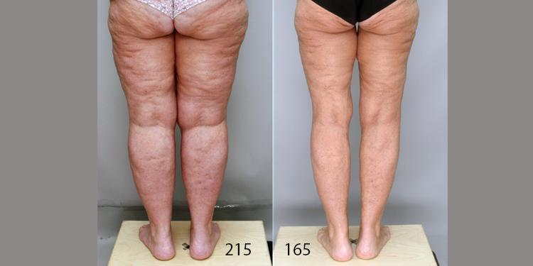 Ditesheim Cosmetic Surgery result — Charlotte, NC