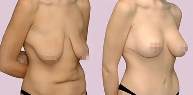 Mommy Makeover result at Ditesheim Cosmetic Surgery in Charlotte, NC
