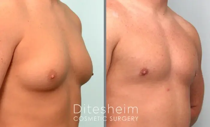 Ditesheim Cosmetic Surgery gynecomastia result — Charlotte, NC