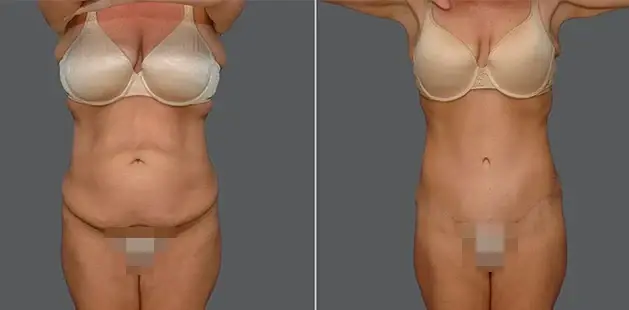 Mommy Makeover result at Ditesheim Cosmetic Surgery in Charlotte, NC