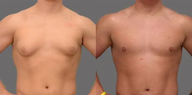 Ditesheim Cosmetic Surgery gynecomastia result — Charlotte, NC