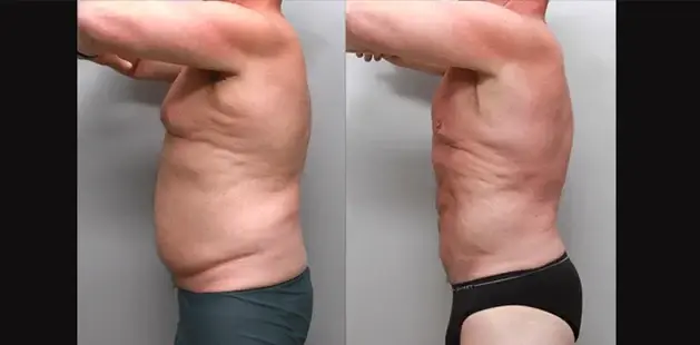 Liposuction result at Ditesheim Cosmetic Surgery in Charlotte, NC