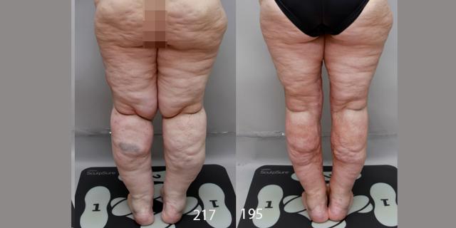 Arm Lift result at Ditesheim Cosmetic Surgery in Charlotte, NC