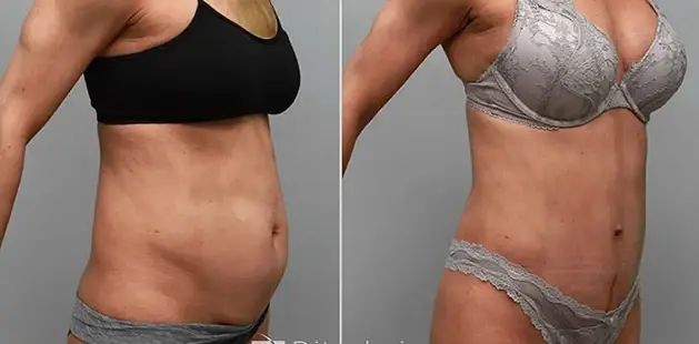 Mommy Makeover result at Ditesheim Cosmetic Surgery in Charlotte, NC