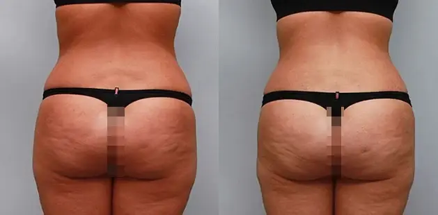 Ditesheim Cosmetic Surgery tummy tuck result — Charlotte, NC