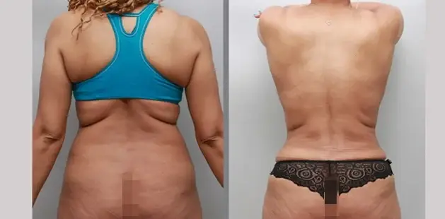 Mommy Makeover result at Ditesheim Cosmetic Surgery in Charlotte, NC