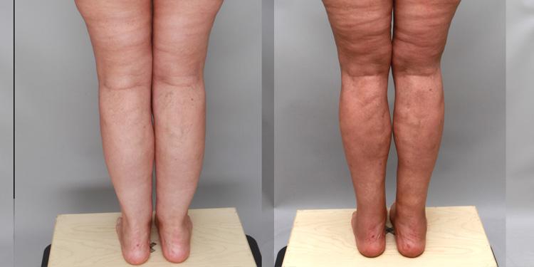 Ditesheim Cosmetic Surgery result — Charlotte, NC