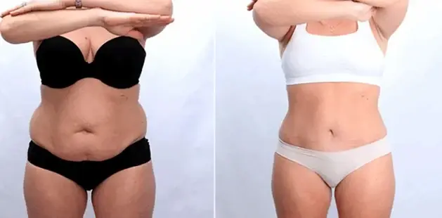 Mini Tummy Tuck result at Ditesheim Cosmetic Surgery in Charlotte, NC