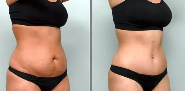 Ditesheim Cosmetic Surgery tummy tuck result — Charlotte, NC