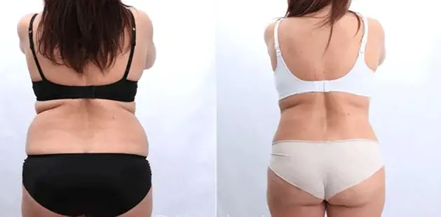 Ditesheim Cosmetic Surgery tummy tuck result — Charlotte, NC