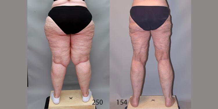 Ditesheim Cosmetic Surgery result — Charlotte, NC