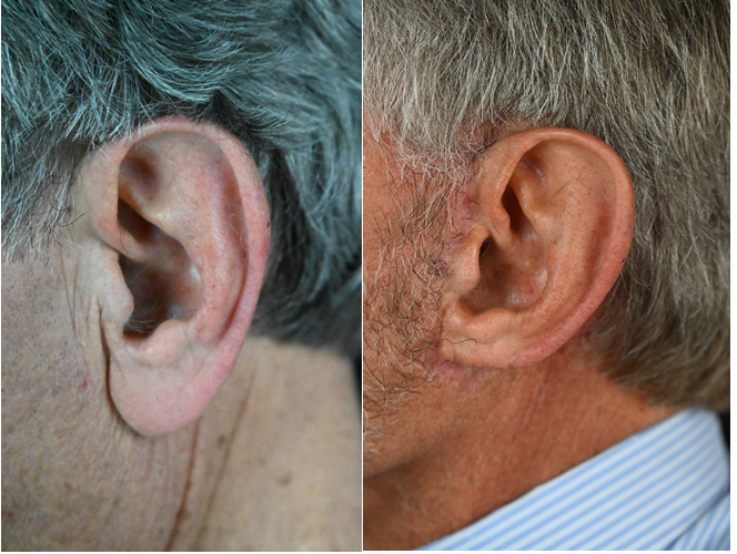 The Aesthetic Surgeon otoplasty result — Longmont, CO
