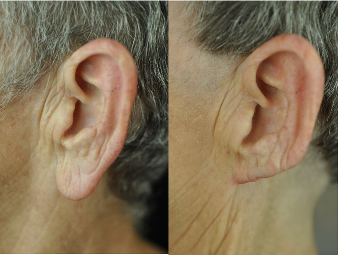 The Aesthetic Surgeon otoplasty result — Longmont, CO