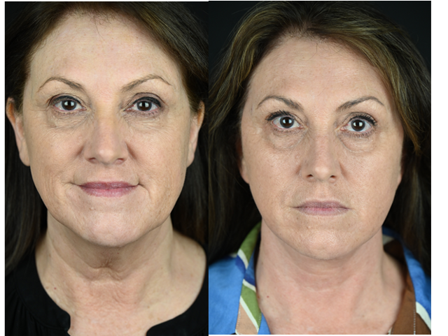 Mini Facelift result at The Aesthetic Surgeon in Longmont, CO
