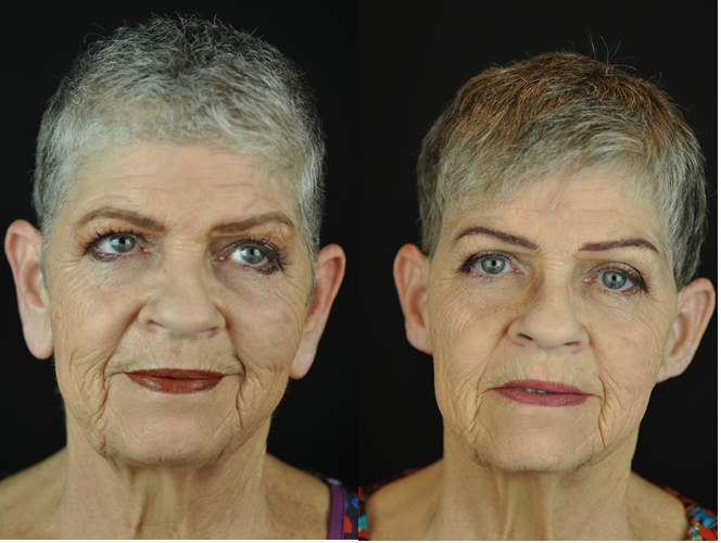 The Aesthetic Surgeon otoplasty result — Longmont, CO