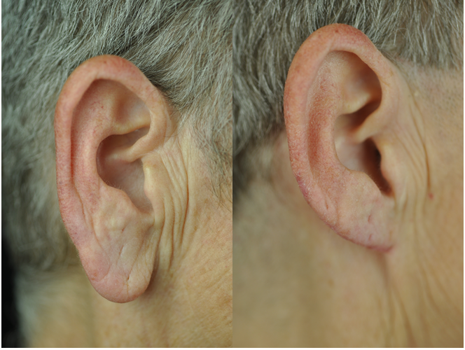 The Aesthetic Surgeon otoplasty result — Longmont, CO