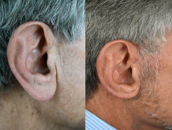 The Aesthetic Surgeon otoplasty result — Longmont, CO