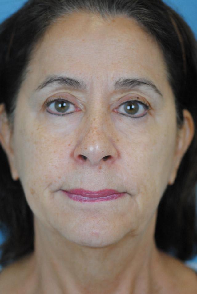 Facelift result at Dr. Thomas Funcik in Mt Pleasant, SC