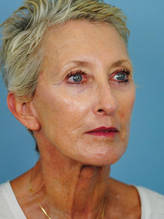 Facelift result at Dr. Thomas Funcik in Mt Pleasant, SC