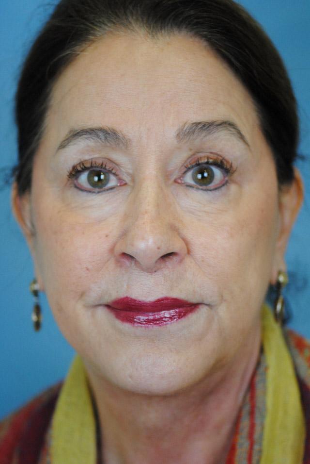 Facelift result at Dr. Thomas Funcik in Mt Pleasant, SC