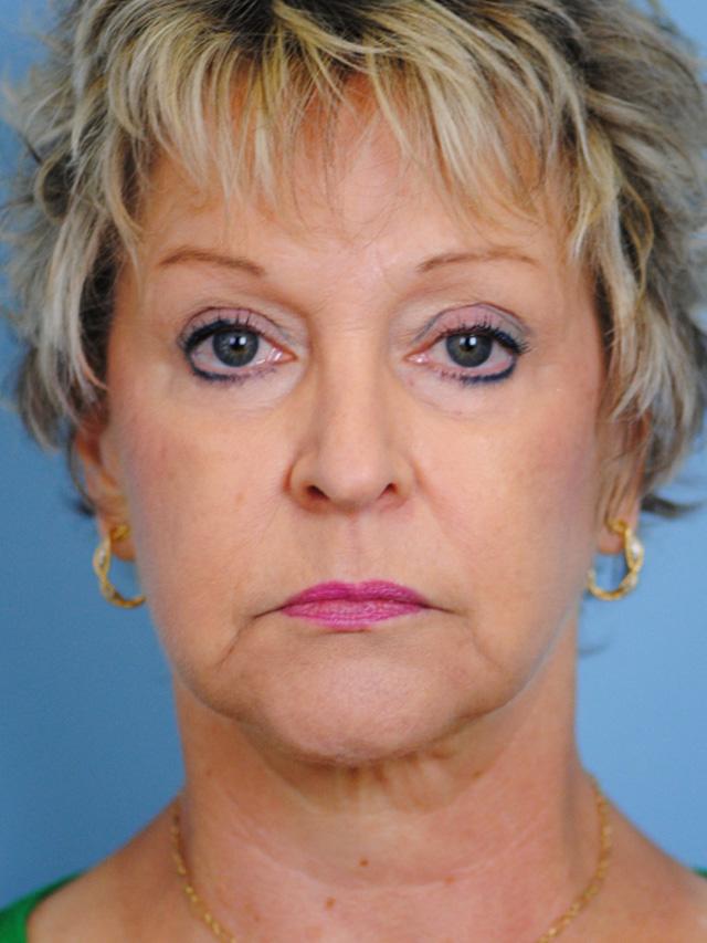 Facelift result at Dr. Thomas Funcik in Mt Pleasant, SC