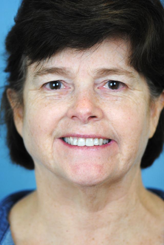 Dr. Thomas Funcik facelift result — Mt Pleasant, SC