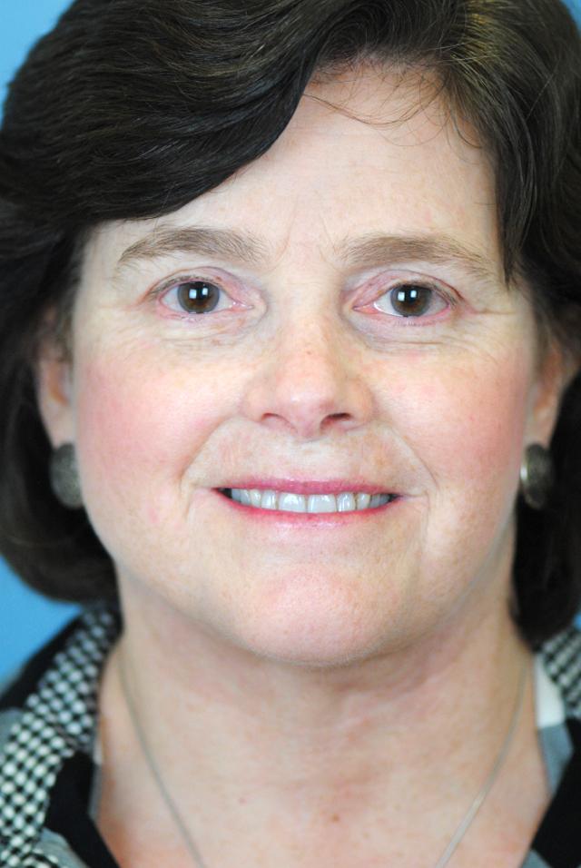 Dr. Thomas Funcik facelift result — Mt Pleasant, SC