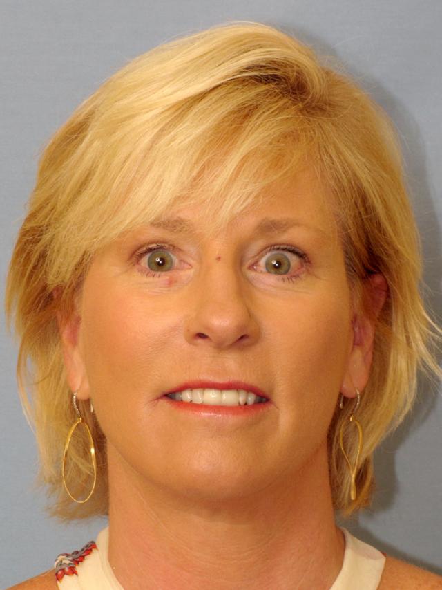 Dr. Thomas Funcik facelift result — Mt Pleasant, SC