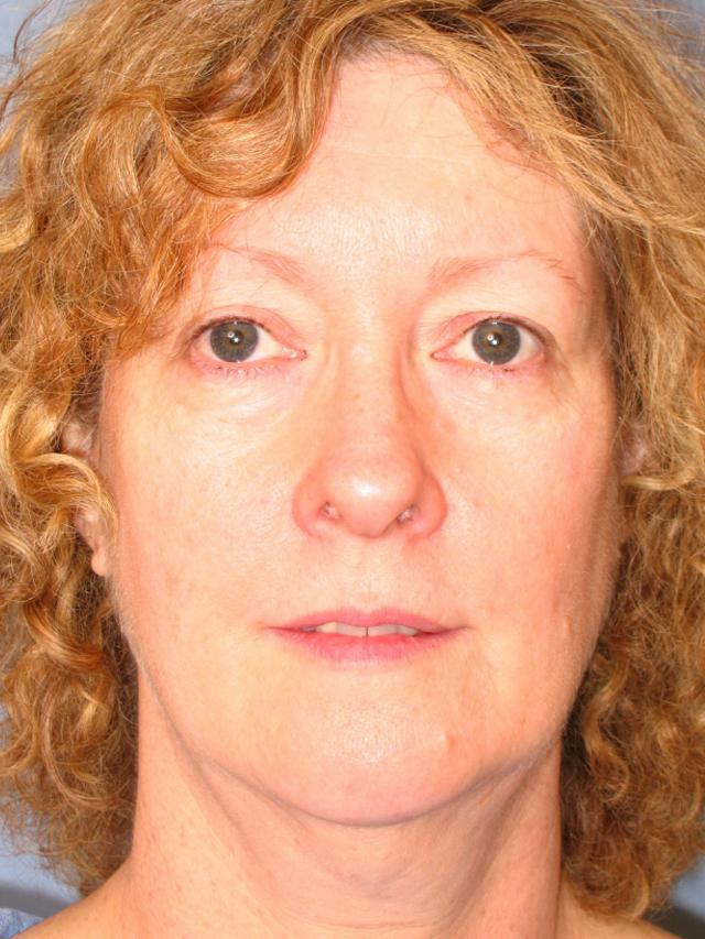 Facelift result at Dr. Thomas Funcik in Mt Pleasant, SC