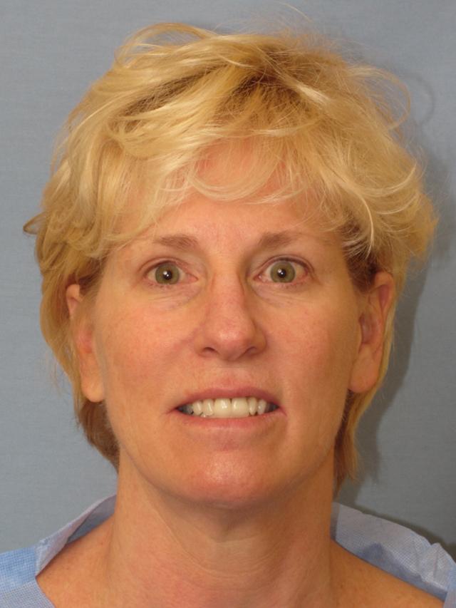 Dr. Thomas Funcik facelift result — Mt Pleasant, SC