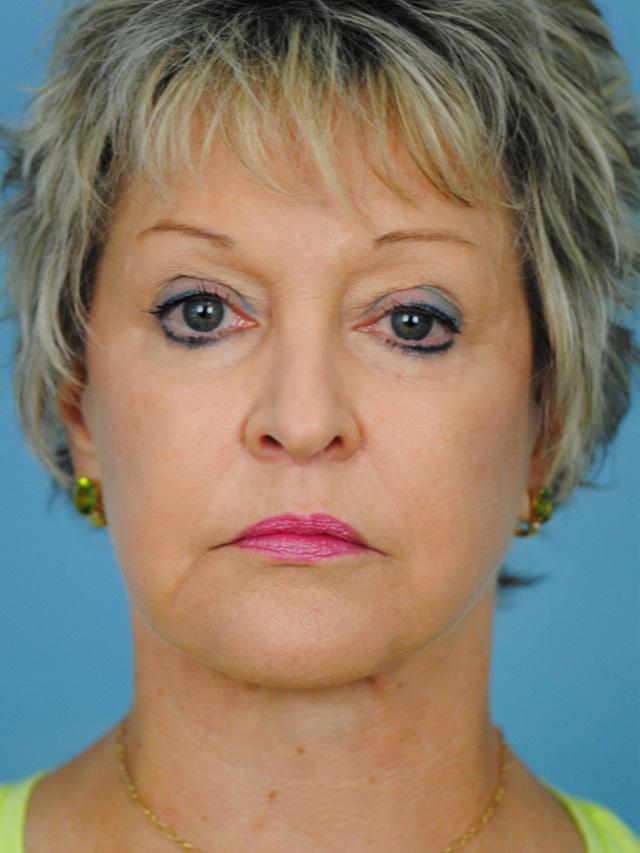 Facelift result at Dr. Thomas Funcik in Mt Pleasant, SC