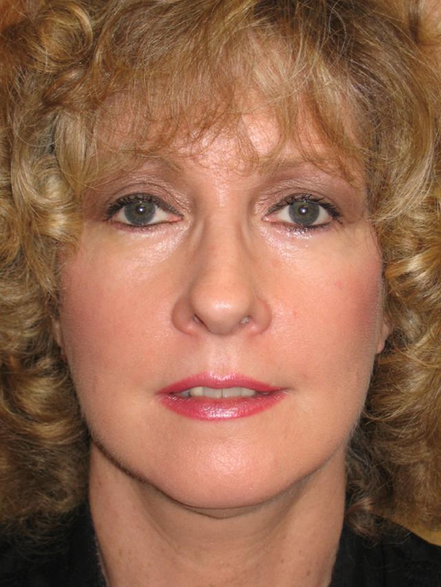 Dr. Thomas Funcik facelift result — Mt Pleasant, SC