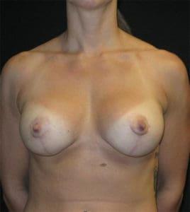 Harold E. Beam, MD breast augmentation after — Glastonbury, CT
