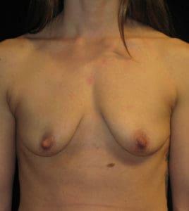 Fat Transfer Breast Augmentation before at Harold E. Beam, MD in Glastonbury, CT