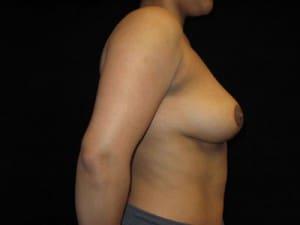 Harold E. Beam, MD breast lift after — Glastonbury, CT