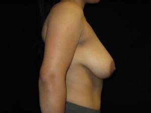 Breast Lift before at Harold E. Beam, MD in Glastonbury, CT