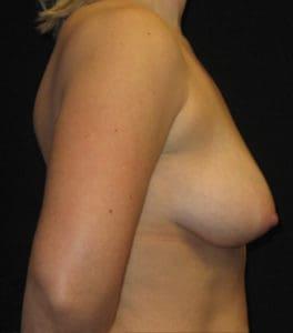 Fat Transfer Breast Augmentation before at Harold E. Beam, MD in Glastonbury, CT