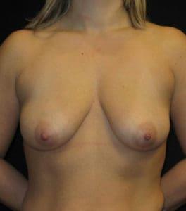 Breast Lift before at Harold E. Beam, MD in Glastonbury, CT