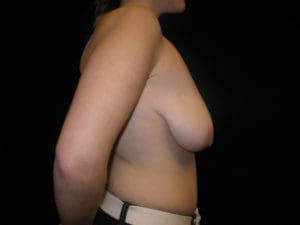 Breast Lift before at Harold E. Beam, MD in Glastonbury, CT