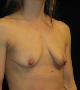 Fat Transfer Breast Augmentation before at Harold E. Beam, MD in Glastonbury, CT