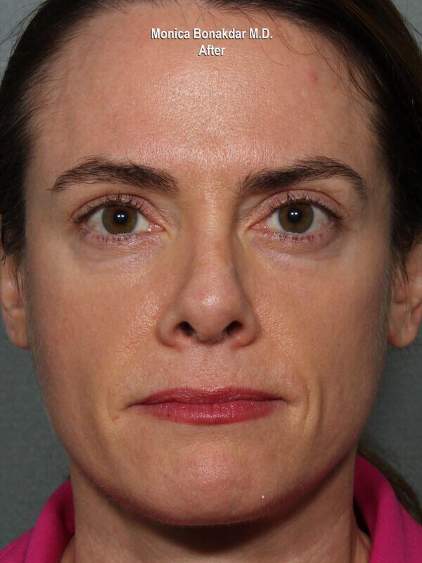 Botox after at Bonakdar Aesthetics in Newport Beach, CA
