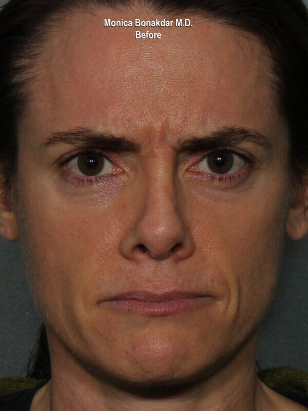 Botox before at Bonakdar Aesthetics in Newport Beach, CA