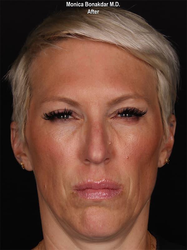 Botox after at Bonakdar Aesthetics in Newport Beach, CA