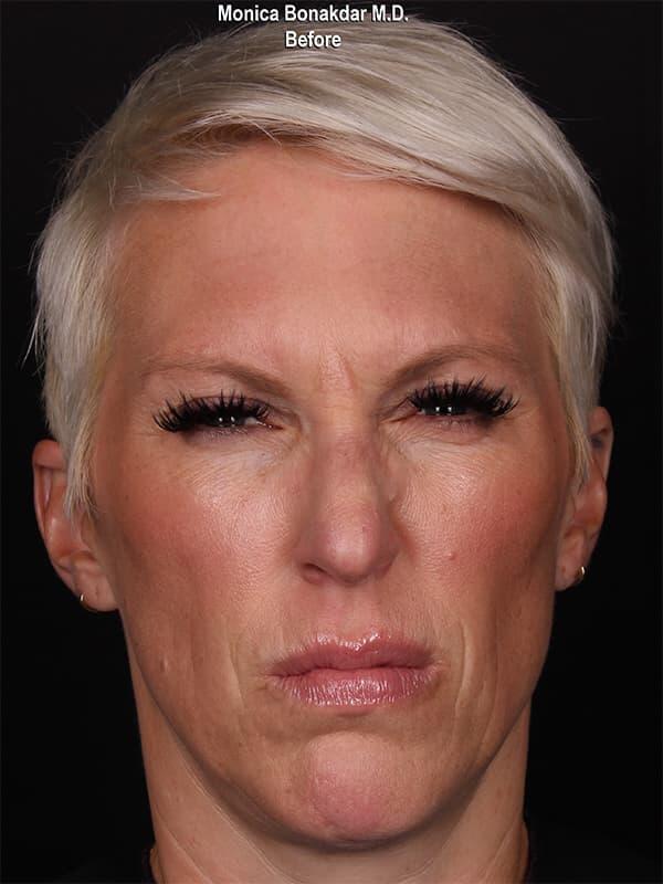 Botox before at Bonakdar Aesthetics in Newport Beach, CA