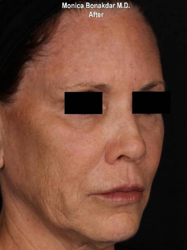 Dermal Fillers after at Bonakdar Aesthetics in Newport Beach, CA